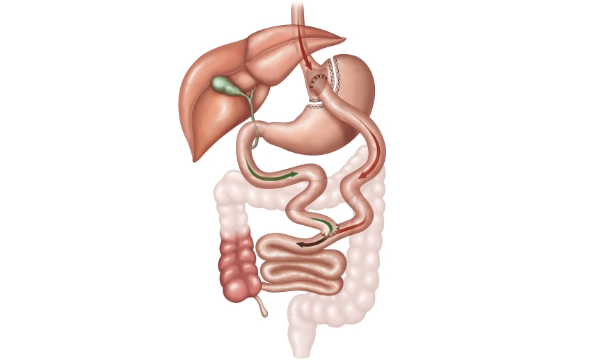 Roux-en-Y Gastric Bypass – TampaGastricSurgery.com